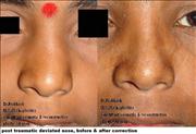 Before After Pictures,Nose job,Rhinoplasty,Delhi,deviated nose rhinoplasty 
